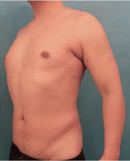 Luxurgery liposuction after — New York, NY