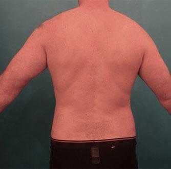 Luxurgery liposuction after — New York, NY