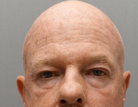 Blepharoplasty before at Luxurgery in New York, NY