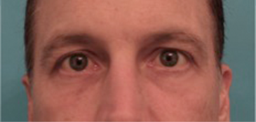 Luxurgery blepharoplasty after — New York, NY