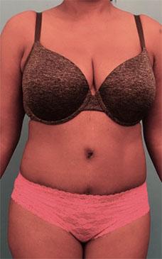 Luxurgery tummy tuck after — New York, NY