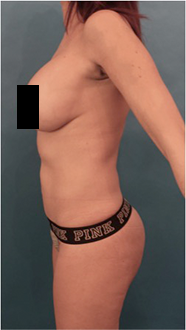 Luxurgery bbl after — New York, NY