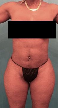 Luxurgery liposuction after — New York, NY