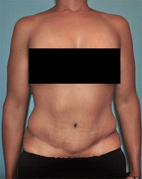 Luxurgery tummy tuck after — New York, NY