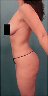 Luxurgery bbl after — New York, NY