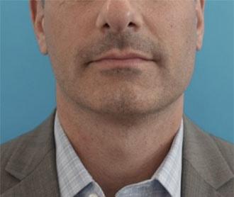 Kybella after at Luxurgery in New York, NY