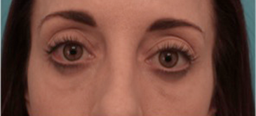 Luxurgery blepharoplasty after — New York, NY