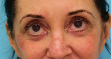 Luxurgery blepharoplasty after — New York, NY
