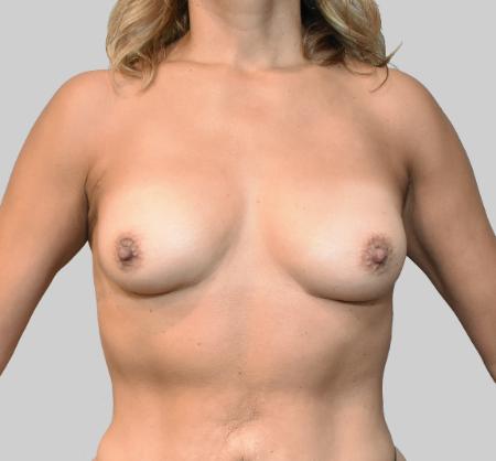 Luxurgery breast augmentation after — New York, NY