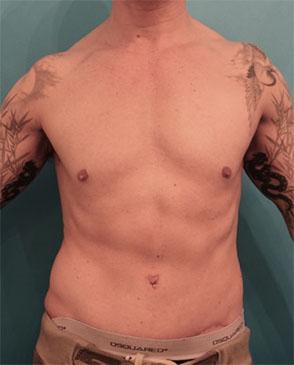 Luxurgery tummy tuck after — New York, NY