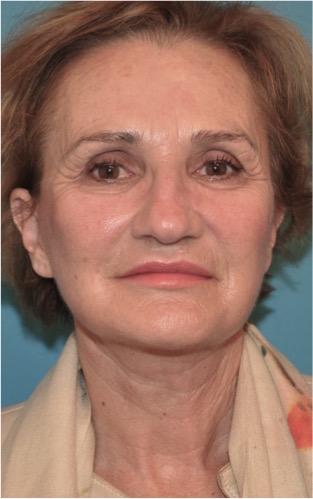 Luxurgery facelift after — New York, NY