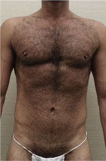 Luxurgery liposuction after — New York, NY
