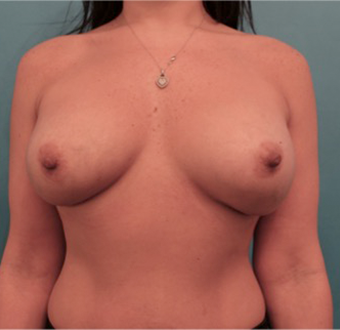 Luxurgery breast augmentation after — New York, NY