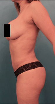 Luxurgery bbl after — New York, NY