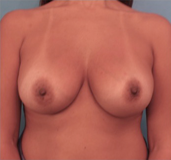 Luxurgery breast augmentation after — New York, NY