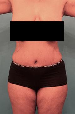 Luxurgery tummy tuck after — New York, NY