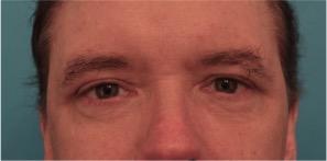 Luxurgery blepharoplasty after — New York, NY