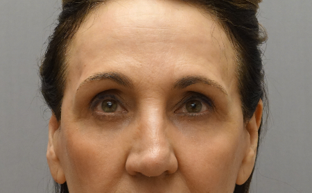 Luxurgery blepharoplasty after — New York, NY