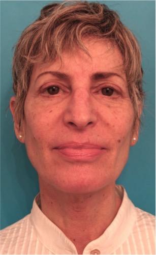 Neck Lift after at Luxurgery in New York, NY