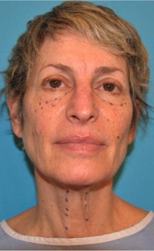 Neck Lift before at Luxurgery in New York, NY