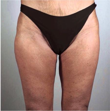 Thigh Lift after at Luxurgery in New York, NY