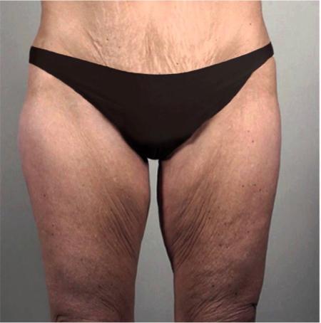Thigh Lift before at Luxurgery in New York, NY