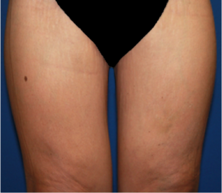 Thigh Lift after at Luxurgery in New York, NY