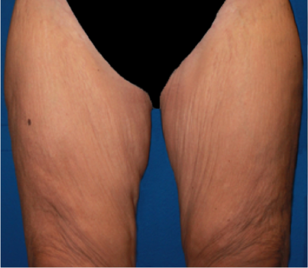 Thigh Lift before at Luxurgery in New York, NY