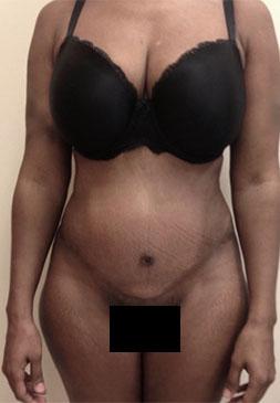 Luxurgery tummy tuck after — New York, NY