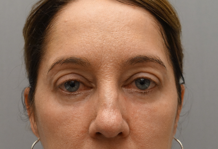 Luxurgery blepharoplasty after — New York, NY