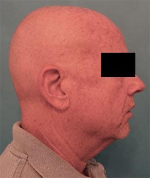 Neck Lift before at Luxurgery in New York, NY