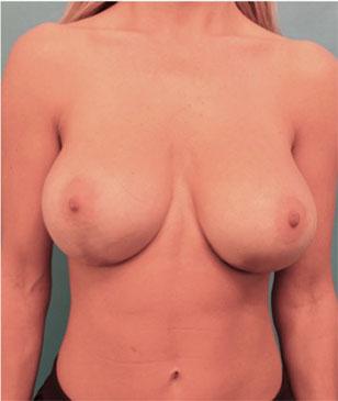 Luxurgery breast augmentation after — New York, NY