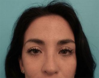 Luxurgery rhinoplasty after — New York, NY