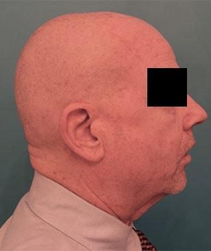 Neck Lift after at Luxurgery in New York, NY