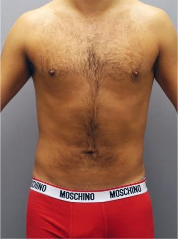 Luxurgery liposuction after — New York, NY