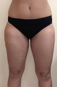 Luxurgery liposuction after — New York, NY