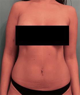 Luxurgery liposuction after — New York, NY