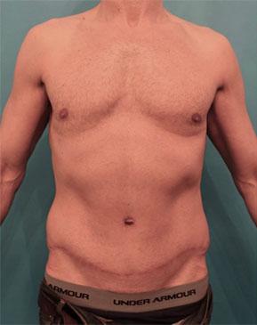Luxurgery tummy tuck after — New York, NY
