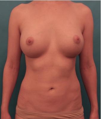 Luxurgery breast augmentation after — New York, NY