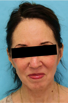 Facelift after at Luxurgery in New York, NY