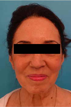 Facelift before at Luxurgery in New York, NY