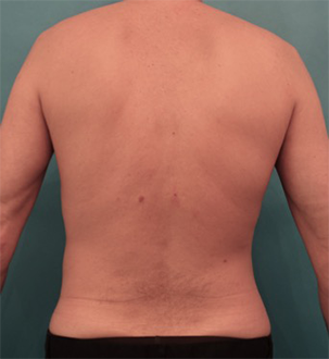 Luxurgery liposuction after — New York, NY