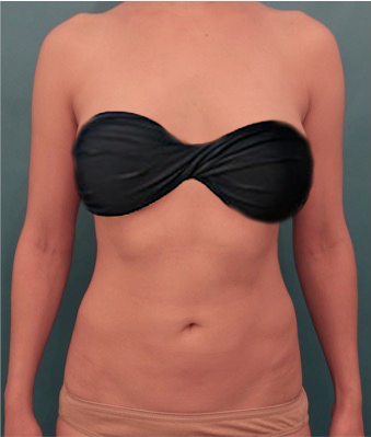 Luxurgery liposuction after — New York, NY