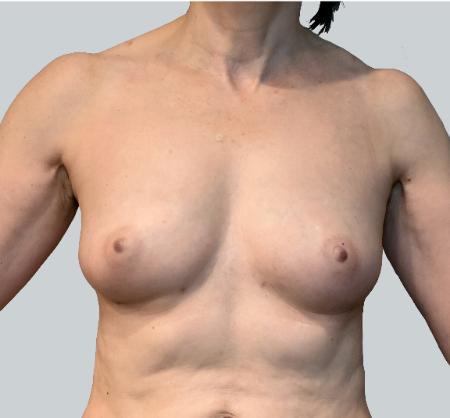 Breast Augmentation after at Luxurgery in New York, NY