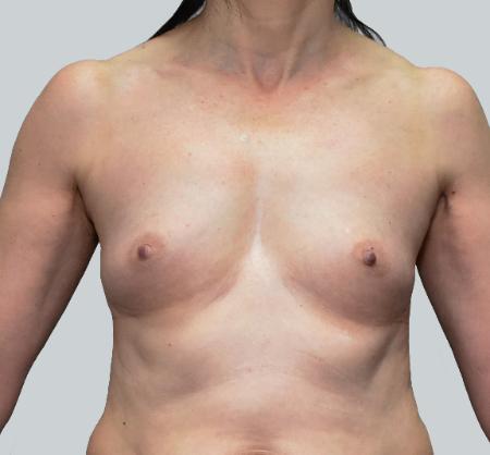 Breast Augmentation before at Luxurgery in New York, NY