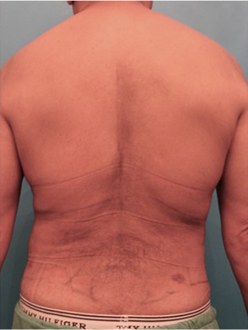 Liposuction after at Luxurgery in New York, NY