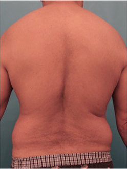 Liposuction before at Luxurgery in New York, NY