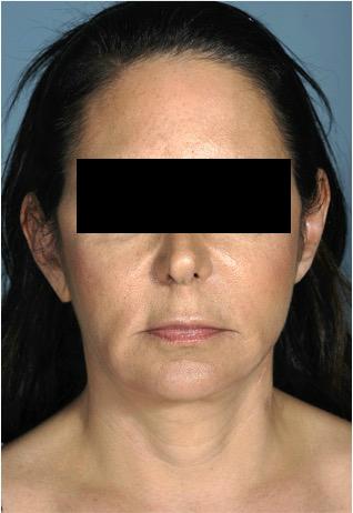Luxurgery facelift after — New York, NY