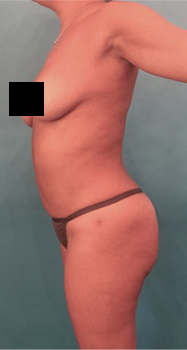 Luxurgery bbl after — New York, NY