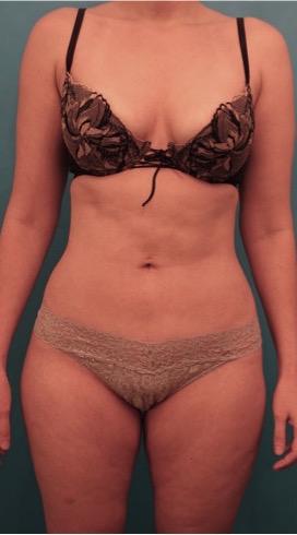 Luxurgery liposuction after — New York, NY